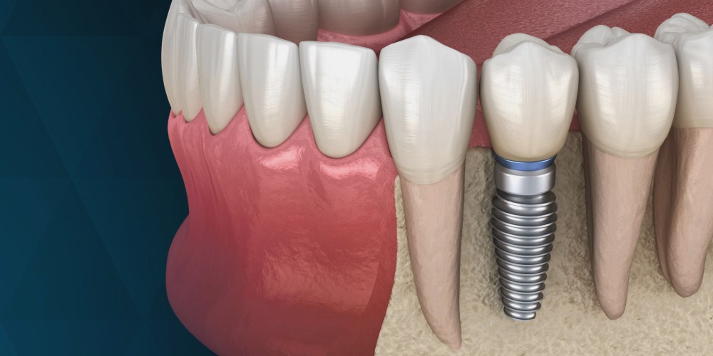 имплант зуба цена brillant.dental