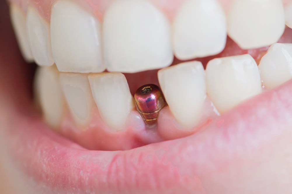 имплант зуба цена brillant.dental